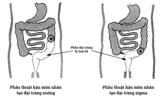 Tìm hiểu về các phẫu thuật hậu môn nhân tạo: vị trí và đặc điểm