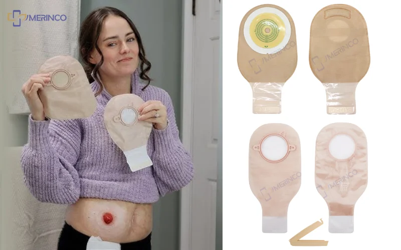 Túi hậu môn nhân tạo 1 mảnh và 2 mảnh