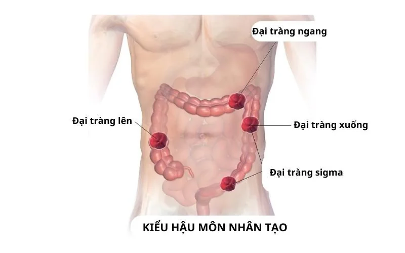 Các loại Hậu môn nhân tạo