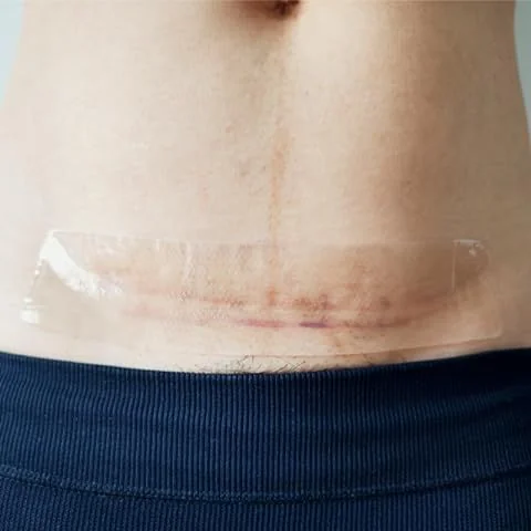 Nên ăn gì để không bị sẹo lồi?