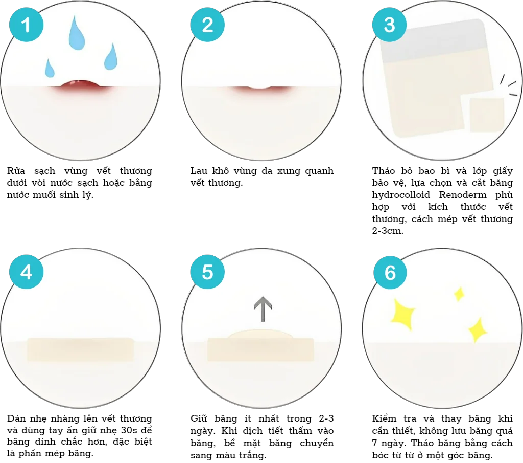 Băng dán vết thương Hydrocolloid Renoderm 10cmx10cm - Miếng dán mụn, bỏng bô