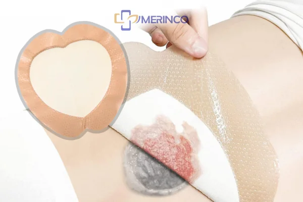 Cách chăm sóc vết loét vùng cùng cụt tại nhà