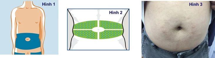 Hình minh họa - BSCC