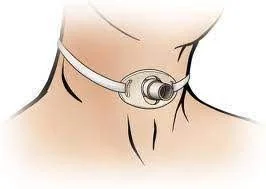 bệnh nhân có mở khí quản luôn được buộc chặt quanh cổ bằng dây buộc.