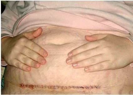 Sẹo mổ sau sinh: Hình ảnh vết mổ sau sinh bị lồi và Cách điều trị