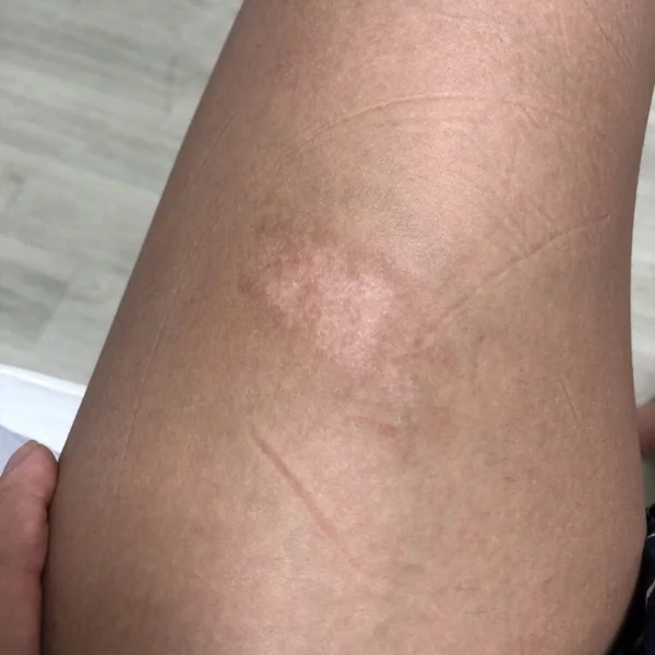 Quá trình cải thiện sẹo khi sử dụng miếng dán ép sẹo RemScar TR