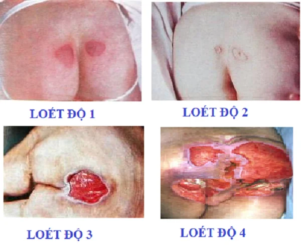 Giaiđoạn phát triển loét tìđè