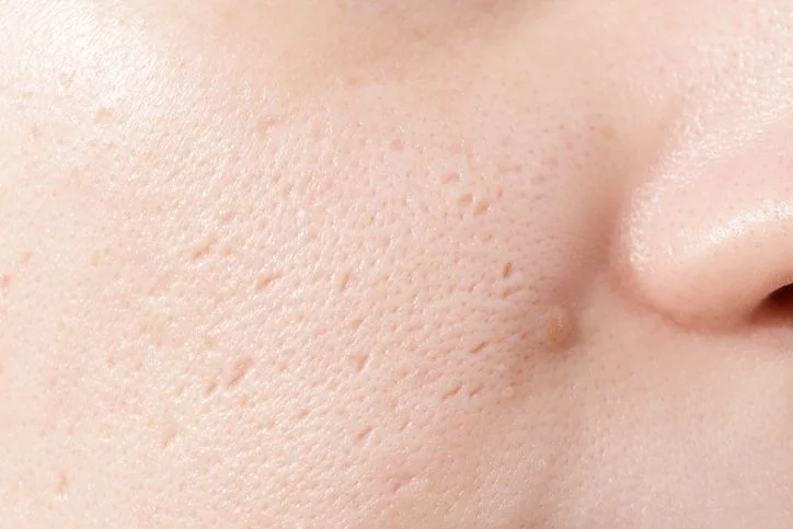 The Frightening Ice Pick Scars| Perfect Medical