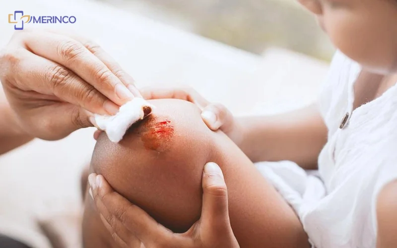 vệ sinh vết thương