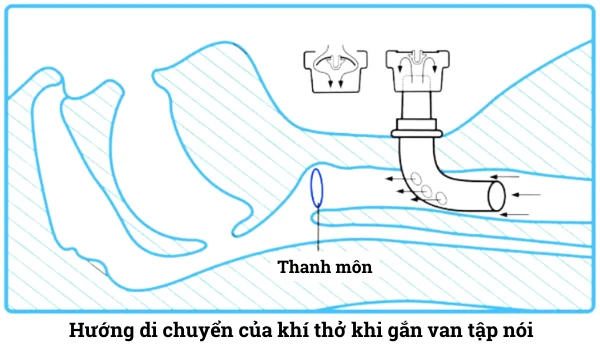 Tất tần tật về van tập nói cho bệnh nhân mở khí quản