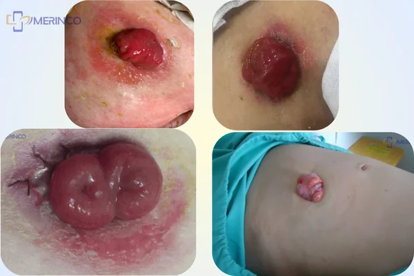 Biến chứng Hậu môn nhân tạo