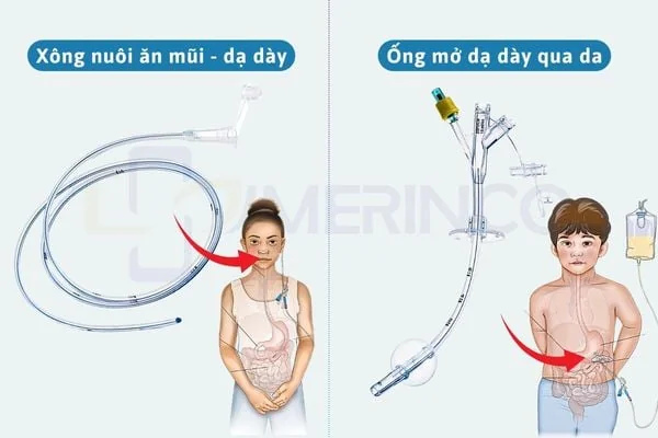 Tổng quan về ống nuôi ăn