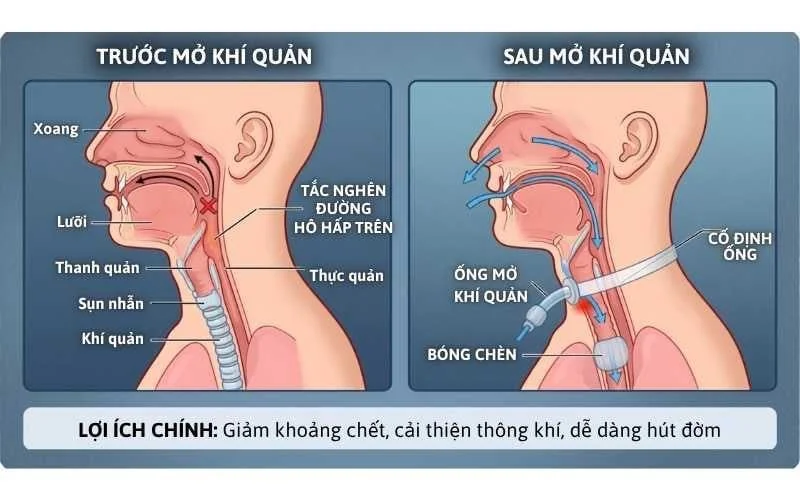 vị trí mở khí quản