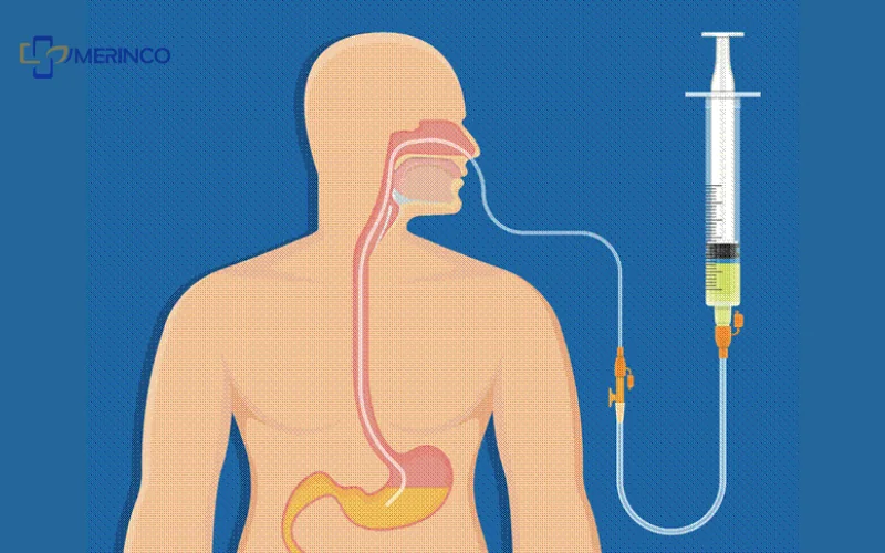sonde nuôi ăn