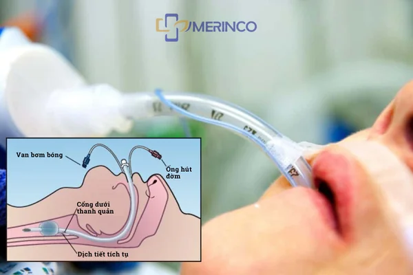 Phân biệt giữa đặt nội khí quản và mở khí quản: Bạn đã biết chưa?