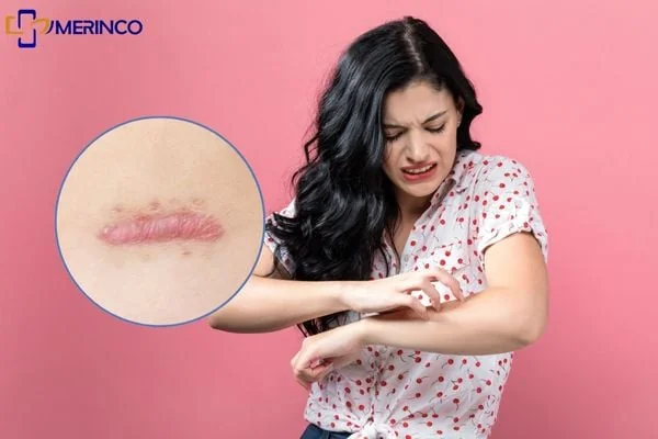 Sẹo lồi hay ngứa do đâu? Có trị hết được không?