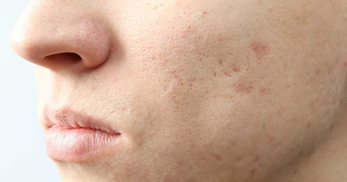 Bị sẹo rỗ lâu năm có phục hồi lại làn da như cũ được không? | Mediworld