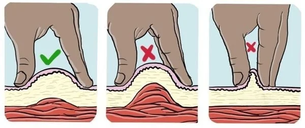 Bạn có cần phải véo da khi tiêm insulin không?