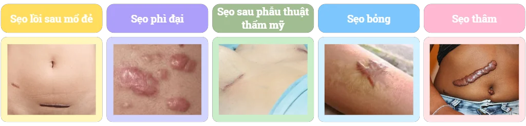 Miếng dán silicone trị sẹo RemScar® TR