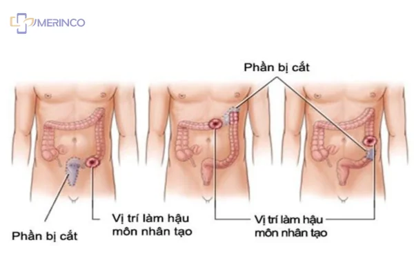 Hậu môn nhân tạo là gì