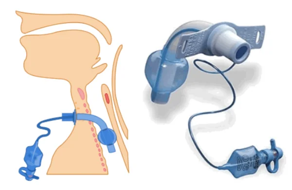 ống mở khí quản có bóng