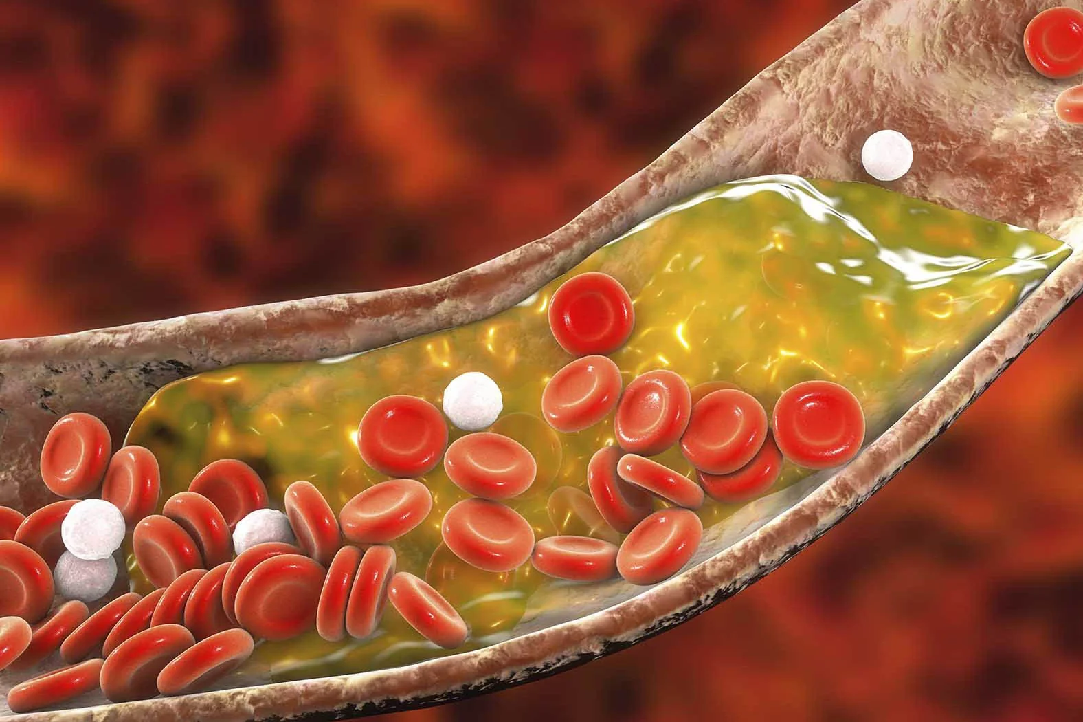 Ai có nguy cơ mắc cholesterol cao?- Ảnh 1. Ai có nguy cơ mắc cholesterol cao?- Ảnh 1.