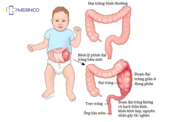 Phình đại tràng bẩm sinh ở trẻ