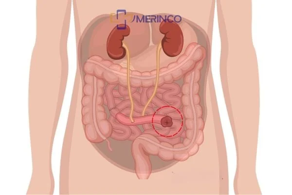 Hậu môn nhân tạo niệu quản: Những điều bạn cần biết