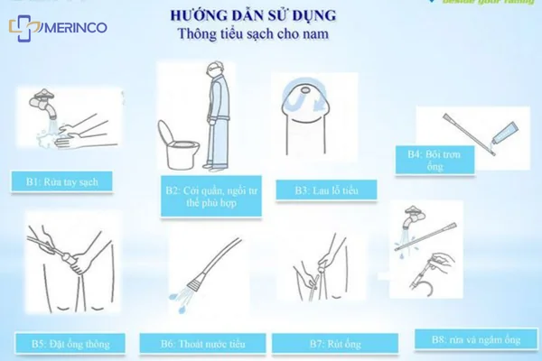 Cách đặt thông tiểu ngắt quãng cho nam