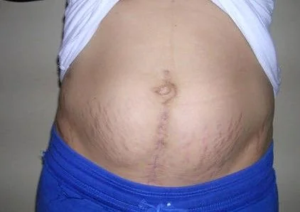 Sẹo mổ sau sinh: Hình ảnh vết mổ sau sinh bị lồi và Cách điều trị