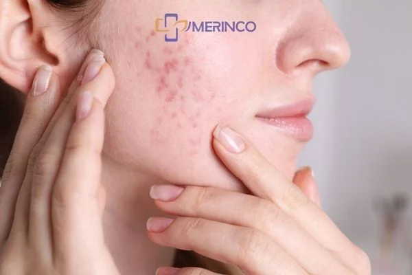 Nguyên nhân gây ra sẹo mụn và cách ngăn ngừa