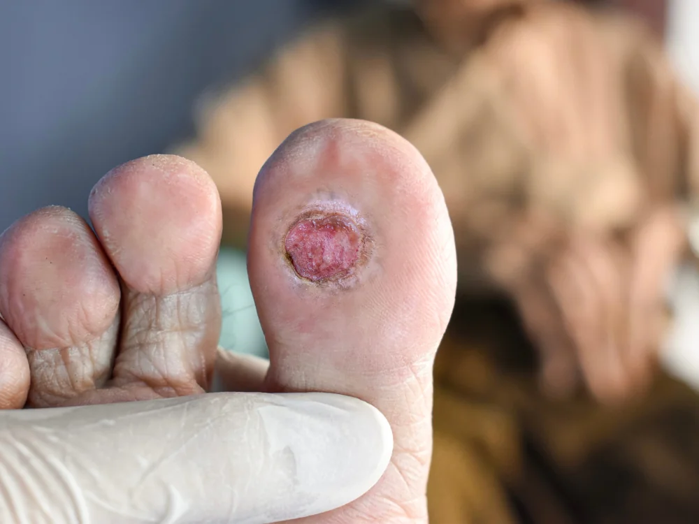 Những nguyên nhân gây bệnh lý thần kinh do đái tháo đường