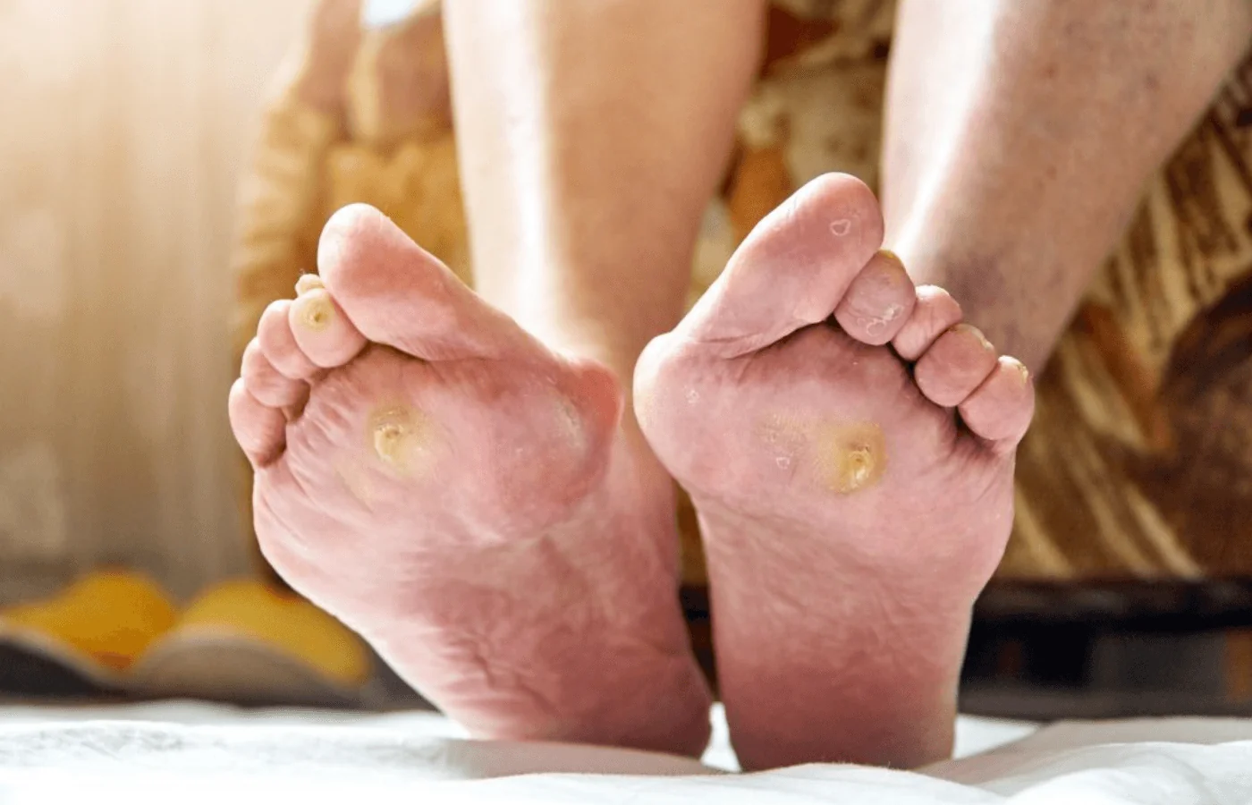 Vết loét nhỏ - Nguy cơ cắt chi lớn: Dấu hiệu cảnh báo bệnh động mạch chi dưới - Bác sĩ mạch máu