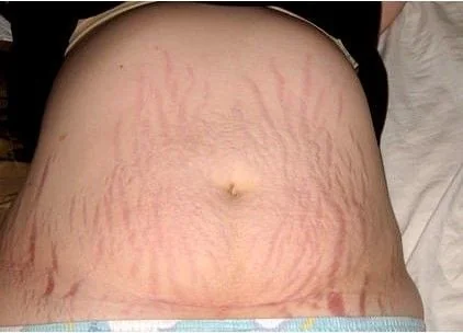 Sẹo mổ sau sinh: Hình ảnh vết mổ sau sinh bị lồi và Cách điều trị