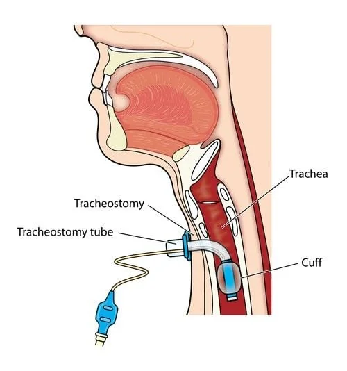 các biến chứng khi phẫu thuật mở khí quản