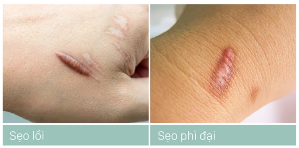 Phân biệt Sẹo lồi vs. Sẹo phì đại - Merinco