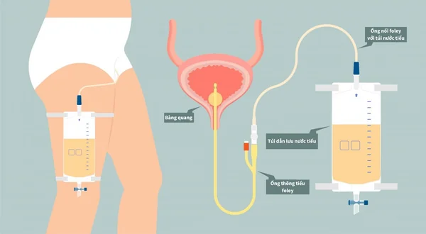 Chăm sóc bệnh nhân đặt ống thông tiểu foley