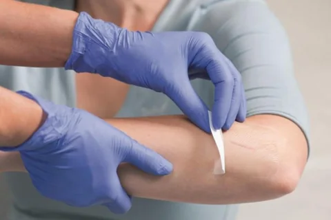 5 Loại Băng Gạc Vết Thương và Thời điểm Thích Hợp Sử Dụng