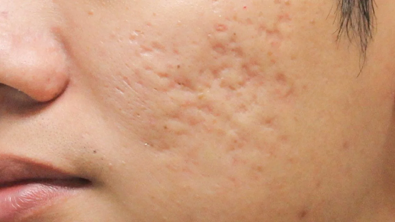 Boxcar Scars: Home Treatments, Causes, and Outlook