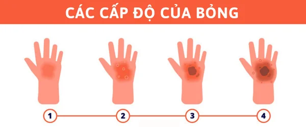 Các cấp độ của bỏng - Trị bỏng tại nhà an toàn