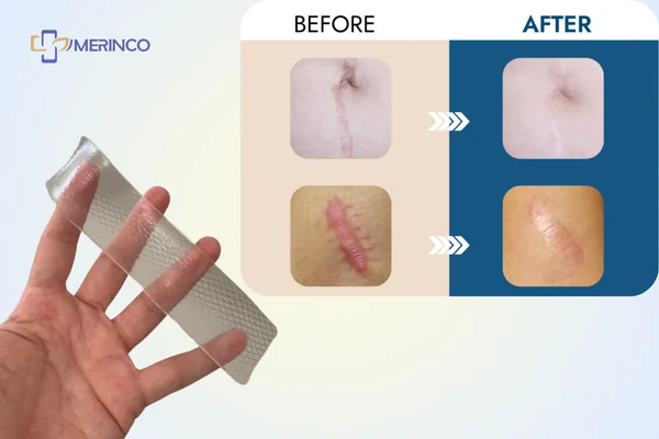 silicone trị sẹo
