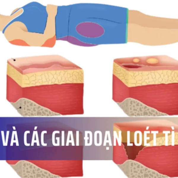 Loét da do tì đè - Phân biệt vị trí và giai đoạn loét