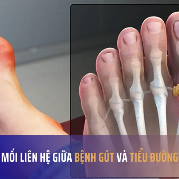 Mối liên hệ giữa bệnh tiểu đường và bệnh gút