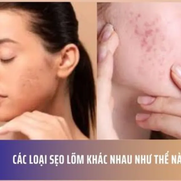 Các Loại Sẹo Lõm Khác Nhau Như Thế Nào