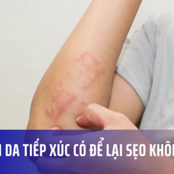 Viêm da tiếp xúc có để lại sẹo không?