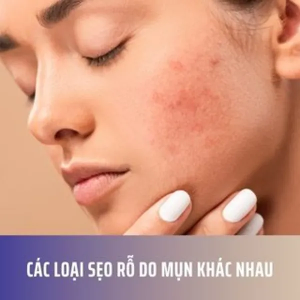 Các Loại Sẹo Rỗ Do Mụn Khác Nhau