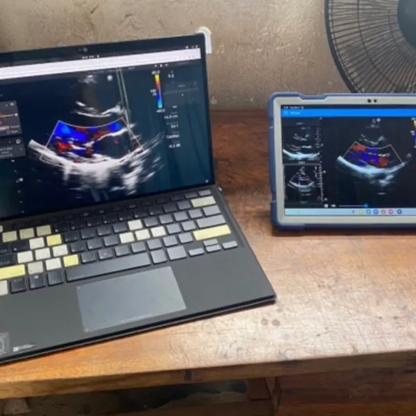 Sử dụng AI chẩn đoán bệnh tim tiềm ẩn ở trẻ