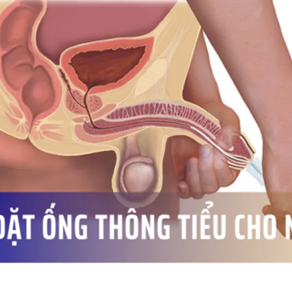 Hướng dẫn cách đặt ống thông tiểu nam