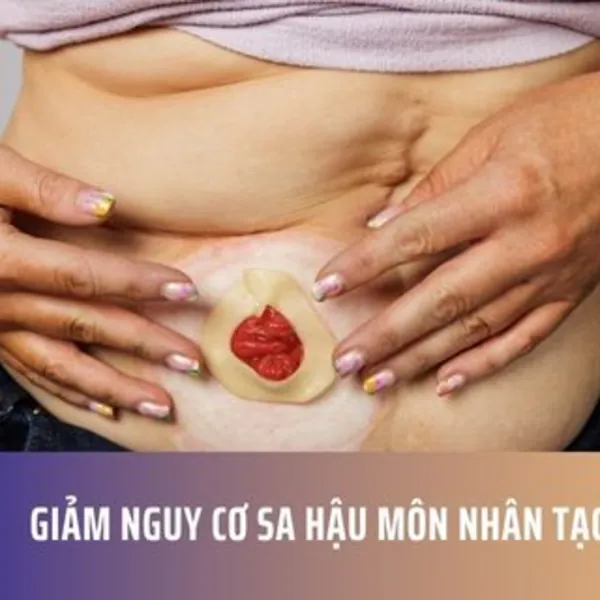 Giảm Nguy Cơ Sa Hậu Môn Nhân Tạo