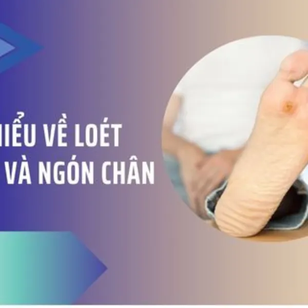 Tìm hiểu về loét chân và ngón chân